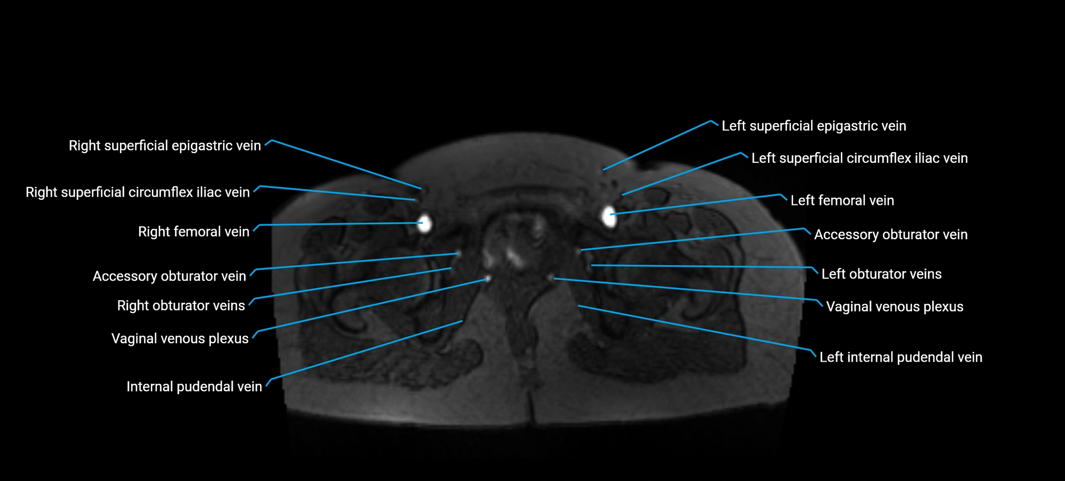 MRV abdomen pelvis & lower limb axial cross sectional anatomy labelled MRI image 187 (1).webp